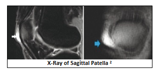 XRay of Sagittal Patella